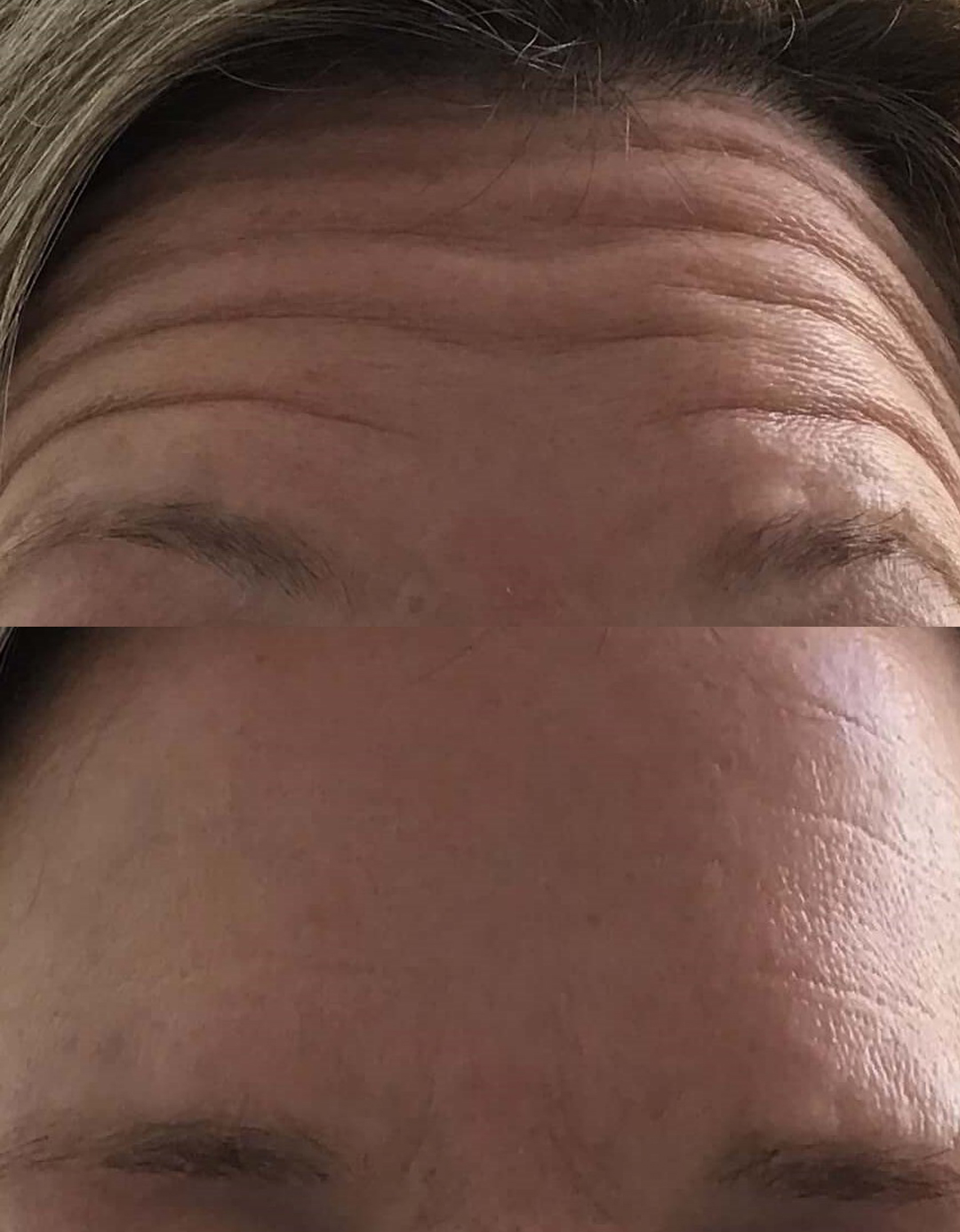 Botox Rejuvenation Before and After