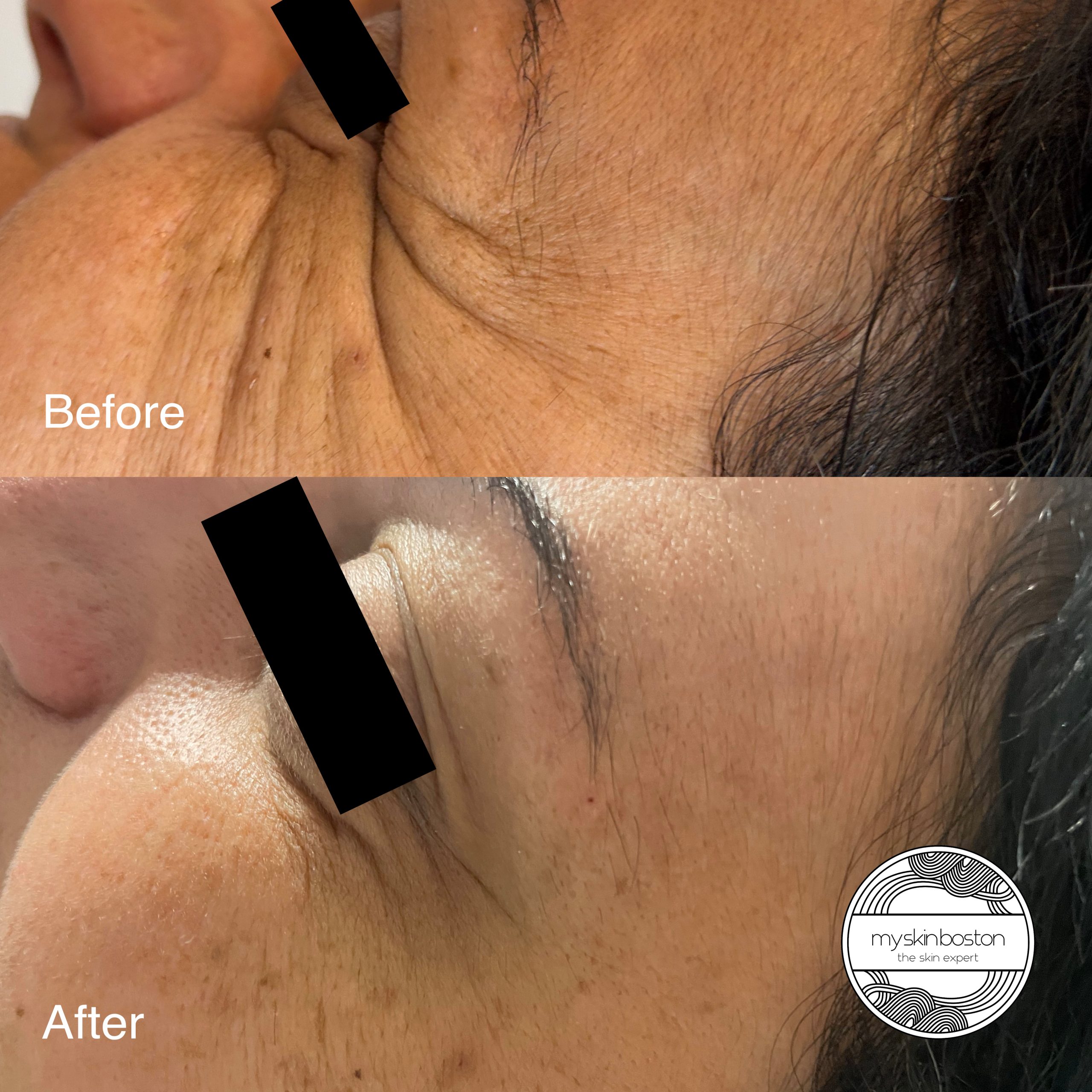 Botox Before and After