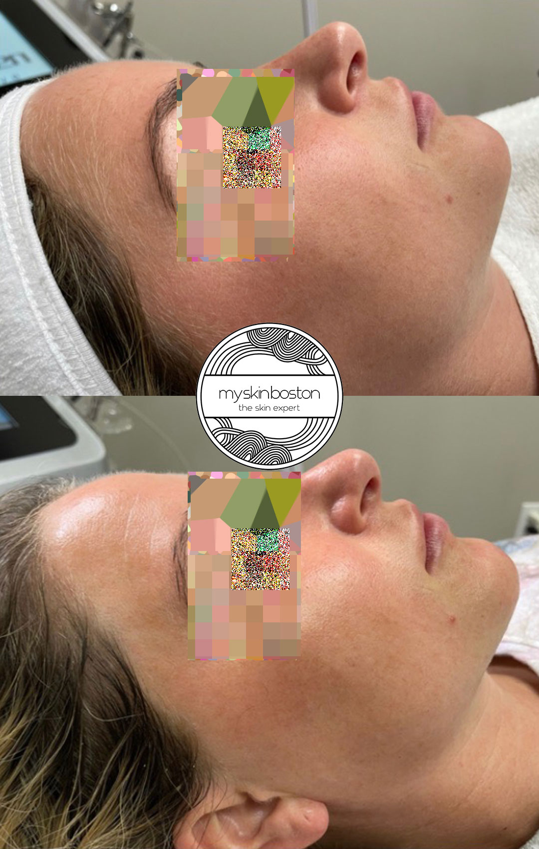Custom Medical Facial Before and After