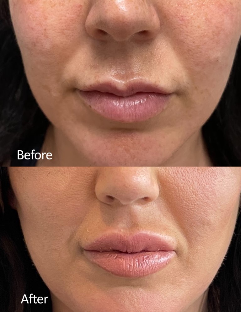 Lip Enhancement Before and After