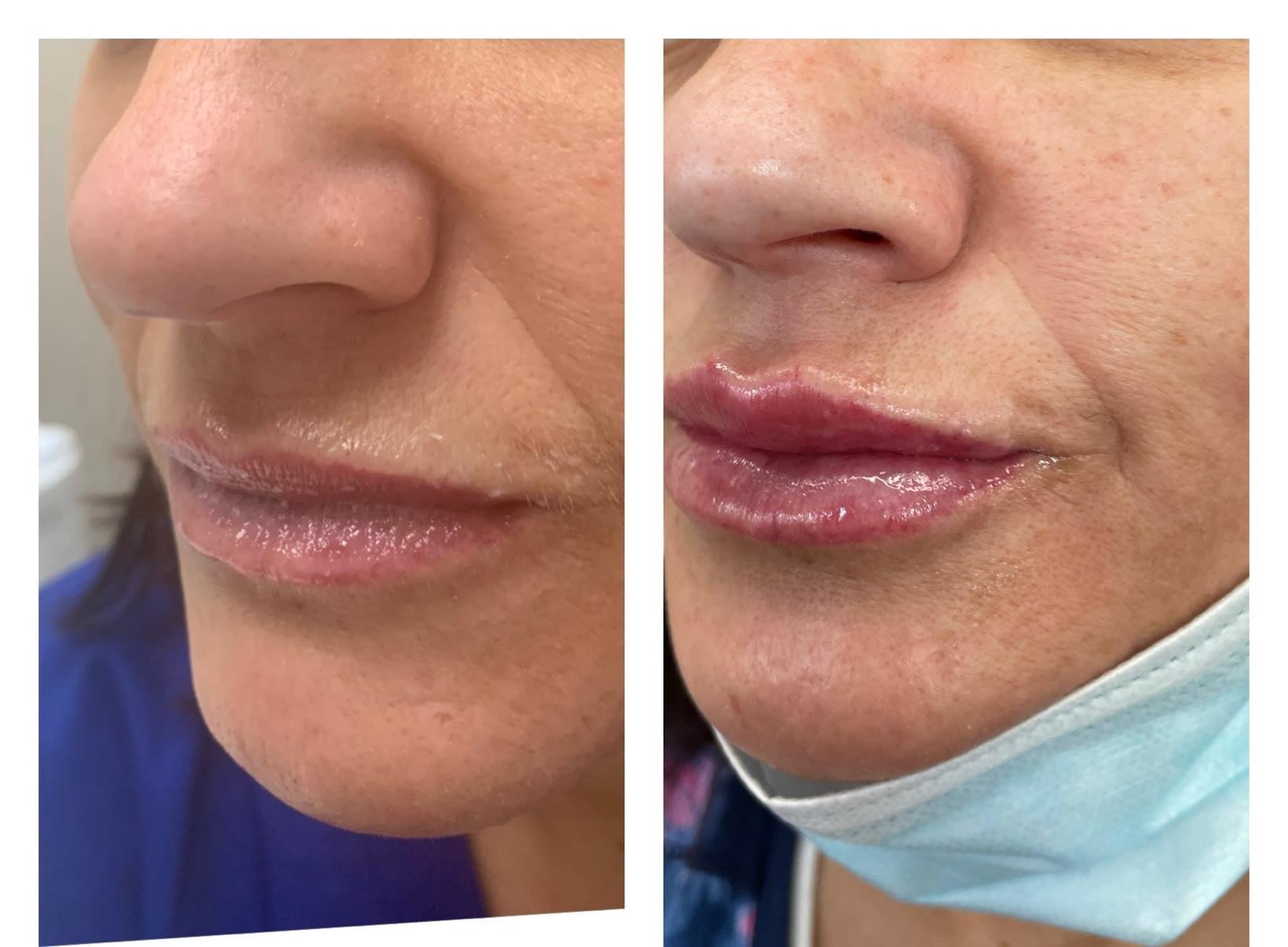 Before & After Lip Fillers