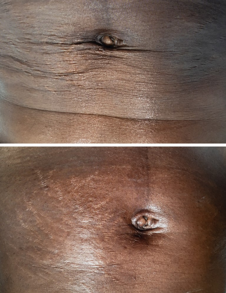 Microneedling Before and After